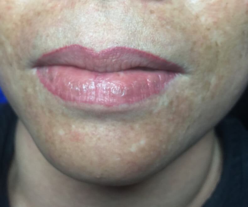 Nên Chọn Phương Pháp Thẩm Mỹ Làm Đẹp Môi Nào Phù Hợp (Cho NAM & NỮ) Thật bất ngờ Nên Chọn Phương Pháp Thẩm Mỹ Làm Đẹp Môi Nào Phù Hợp (Cho NAM & NỮ) Thật bất ngờ