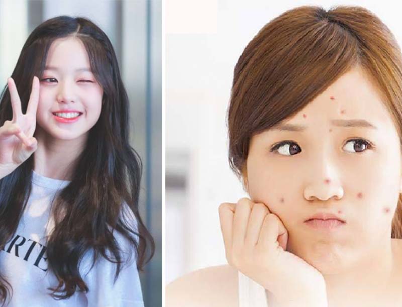 kem tri mun tuoi teen