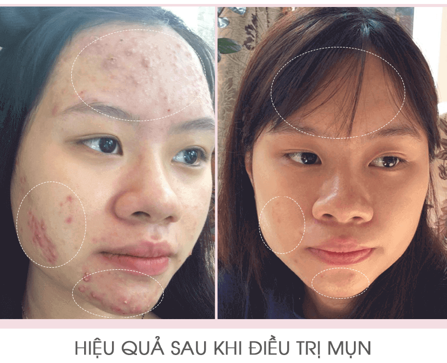 trị mụn chuẩn y khoa