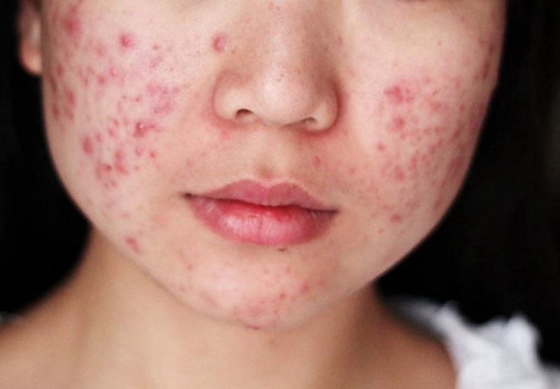 đi spa trị mụn