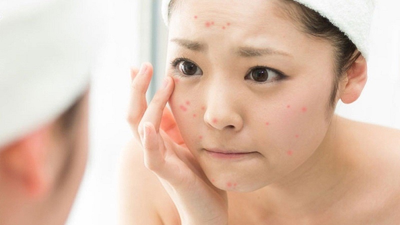 spa trị mụn ở sài gòn