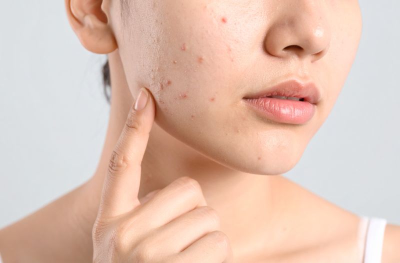 Các yếu tố làm trầm trọng thêm tình trạng lỗ chân lông