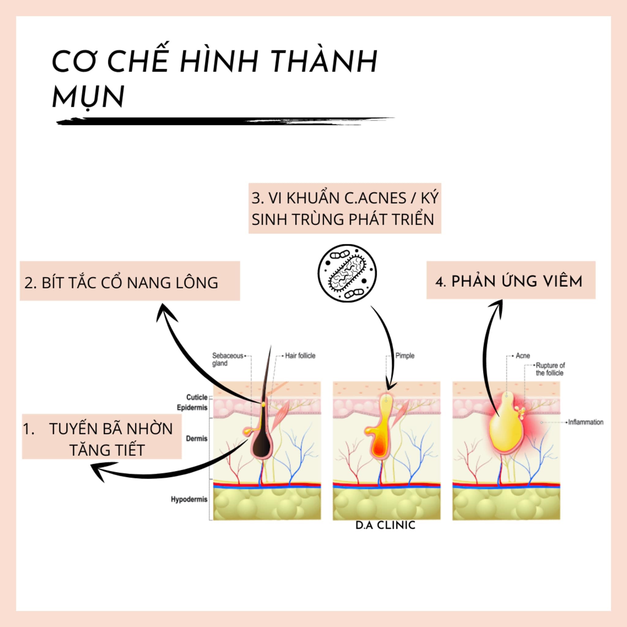 1. Cơ Chế Hình Thành Mụn