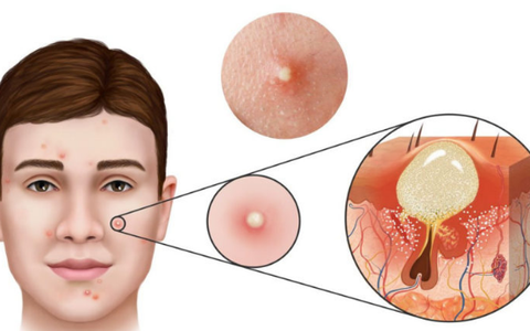 tất tần tật về mụn