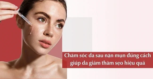 chăm sóc da sau nặn mụn