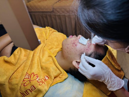 juna spa tân phú lấy nhân mụn