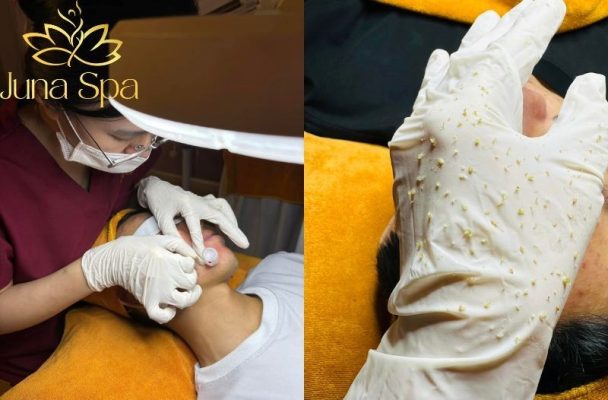 juna spa lấy nhân mụn uy tín